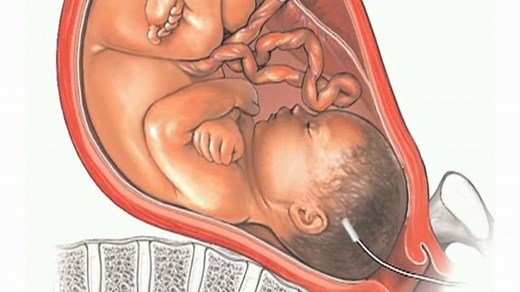 AWHONN | IUPC & FSE Placement | 2014