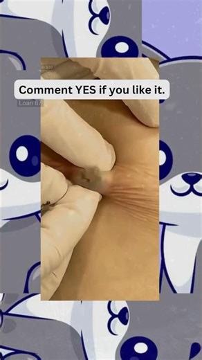 🔥Deep Blackheads, Milia & Whitehead Removal pimple popping New| Big Cystic Acne Extraction