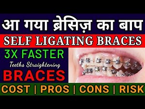 Self Ligating Braces क्या होते हैं | Cost | Pros and Cons | 3X Fast Teeth Aligning Braces | A 2 Z |
