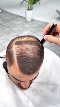 Thin Hair? Watch the Scalp Disappear in Seconds