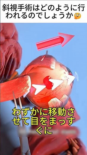 How is strabismus surgery performed?