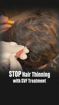 SVF Treatment for Hair Loss | Stem Cell Hair Regrowth Treatment