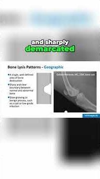 Bone Lysis Patterns Explained: Geographic, Moth-Eaten, Permeative #shorts