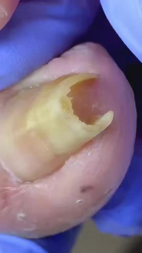 This toenail exposed something unimaginable HZIY Beautiful moments of care and relaxation through a gentle pedicure experience. Simple, clean, and satisfying. 🌿✨ Disclaimer: This video is for educational and relaxation purposes only. All content belongs to the respective owners, no copyright infringement is intended. | 𝗜𝘁’𝘀 𝗢𝗸𝗮𝘆ヅ