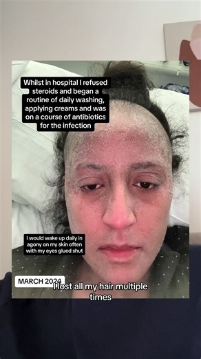 My Dupixent Journey and TSW Experience Update