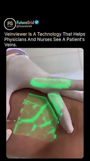 VeinViewer Tech Lets Doctors See Veins Instantly | Amazing Medical Innovation