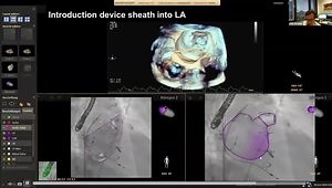 LAA Fusion Imaging: What Are the Benefits of Echo/Fluoroscopy and CT/Fluoroscopy Fusions?