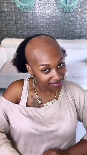 Frontal Fibrosing Alopecia: Understanding and Supporting Those Affected