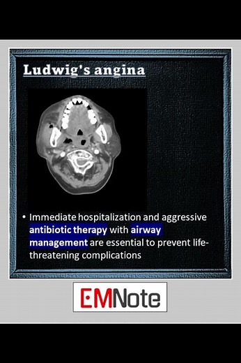 Ludwig's Angina #medical #doctor #nursing