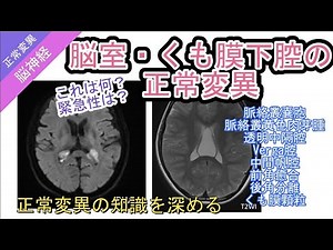脳室・くも膜下腔の正常変異