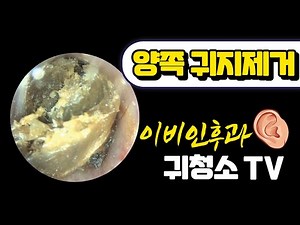 Ear Wax Removal (Cerumen Impaction)