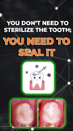 Should You Leave Caries Behind? The Research Says YES 🦷