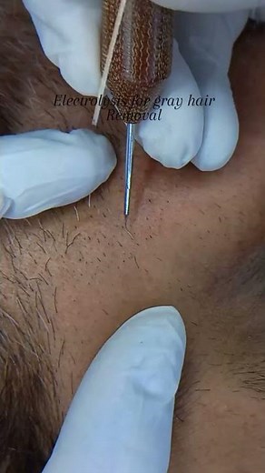 Electrolysis hair removal