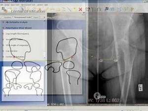 TraumaCad - Acetabular Index