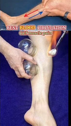 calf muscle pain relief for Fire 🔥 cupping! blood circulation improve! #shortsfeed #viral #youtube