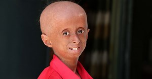 Most rare diseases: 6 rare diseases you've probably never heard of