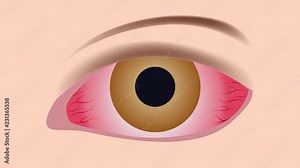 Conjunctivitis. pink and red inflammation eye graphic animation