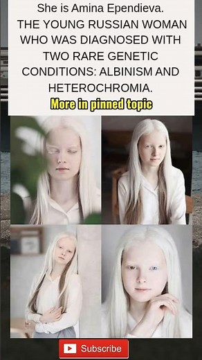 The young Russian woman was born with two rare genetic conditions: albinism and heterochromia.