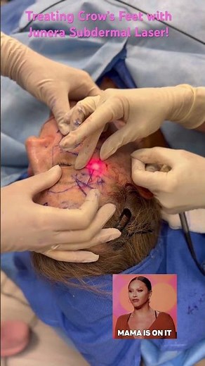 Treating Crows Feet with Junera Nonsurgical Laser under the Skin