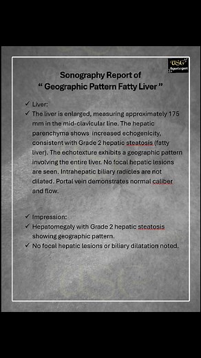 Sonography report of Geographic pattern fatty liver 😲 #ultrasoundscan #radiology #sonologist #Radiologist #medical #medicalstudent #medicalimaging #MedicalReport #ultrasound | Ultrasound report expert