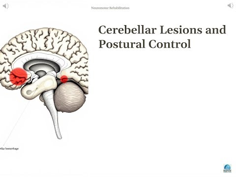 1-14. Diseases Affecting Postural Control: Cerebellar Damage