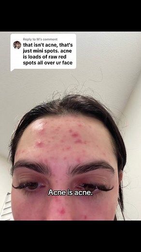 Understanding Acne: Severity and Impact on Mental Health