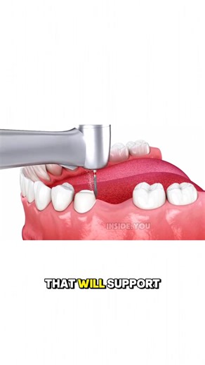 How a Dental Bridge Is Placed on Your Teeth #DentalBridge #toothreplacement #dentalprocedure #oralhealth #smilefix | Life Health.