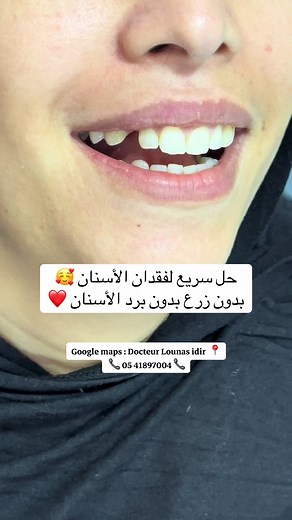Solution esthétique pour remplacer une dent manquante