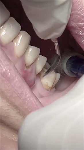 Scaling tartar and calculus off posterior teeth 🦷 #dentalclinic