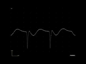Waxing-waning discharge from a denervated muscle