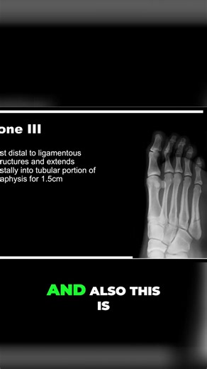 Foot Fracture Zone 3 - Causes, Risks, and Why Athletes Get It