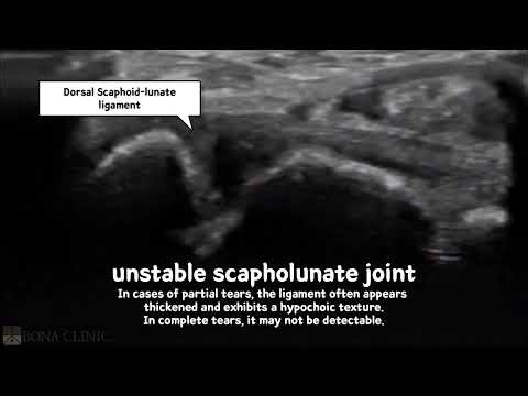 Wrist Clicking and Weakness After an Injury? Understanding Scapholunate Instability