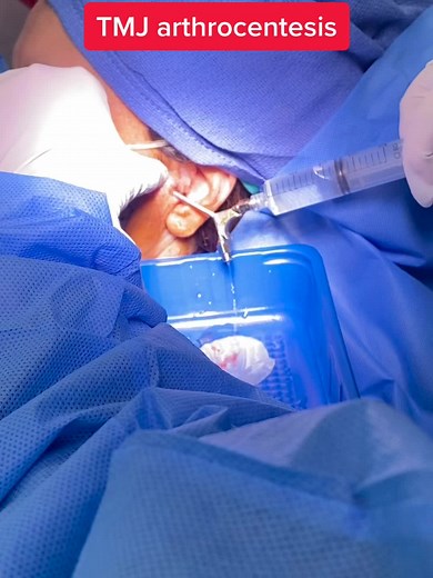 Arthrocentesis is a procedure performed to aspirate synovial fluid from a joint cavity. #drjawline #tmjdisorder #tmjtreatment