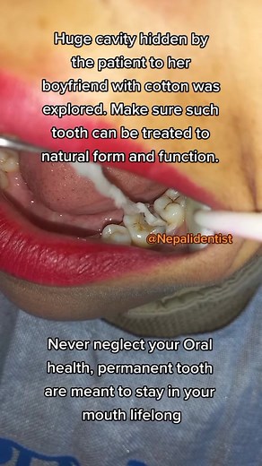 Preventing and Treating Huge Tooth Cavity: A Dental Guide