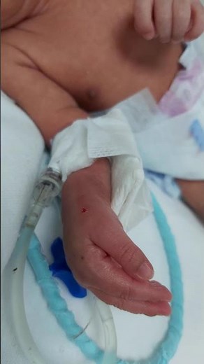 case 389 boils (abscesses) after drainage,S.aureus skin infection at line insertion,hidden morbidity