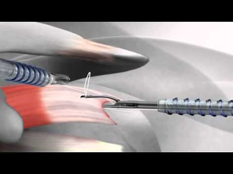 Arthrex SutureBridge™ rotator cuff repair