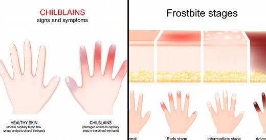 Knowing The Differences Between Chilblains And Frostbite Could Save Your Fingers