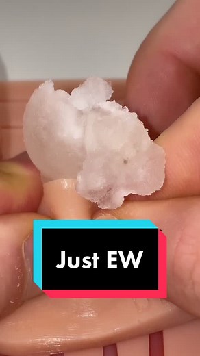 Draining Abscess Procedure Revealed | You Be the Doc