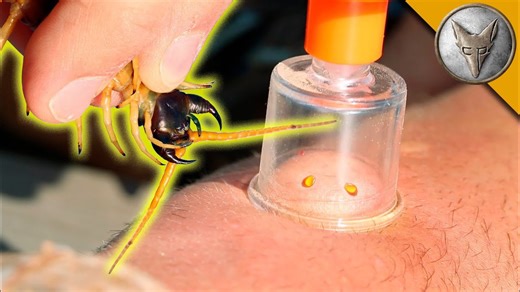 Venom Extraction After a Centipede Bite