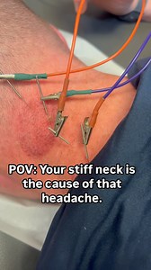 🏆 Cervicogenic Headaches: When Neck Tension Triggers Head Pain ◼️ What It Is: ▫️ Cervicogenic headaches stem from dysfunction in the neck, particularly in the upper cervical spine. ▫️ Tight muscles, poor posture, or joint restrictions can irritate nerves and refer pain to the head, temples, or even behind the eyes. ◼️ Why It Matters: ▫️ Unlike typical headaches, cervicogenic headaches won’t go away with painkillers—they need targeted treatment to relieve the neck tension causing the pain. ▫️ Ig