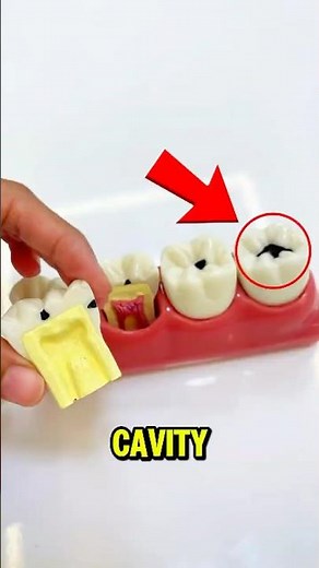Never Ignore a Small Cavity… Here's Why! 😳🦷
