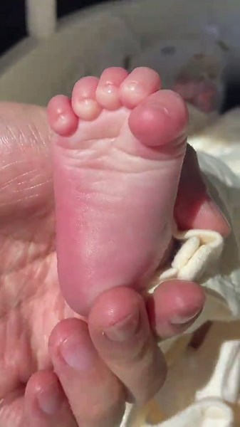 Os estímulos do recém-nascido são respostas reflexas naturais que o bebê apresenta logo após o nascimento. Eles mostram se o sistema nervoso do bebê está funcionando bem. Na enfermagem e na neonatologia, esses reflexos são muito observados na avaliação inicial do bebê. 👶 1. Reflexo de Moro (reflexo do susto) •\tOcorre quando o bebê leva um susto ou sente mudança brusca de posição. \t•\tO recém-nascido abre os braços, estica as pernas e depois recolhe. \t•\tNormal até aproximadamente 4 a 6 meses