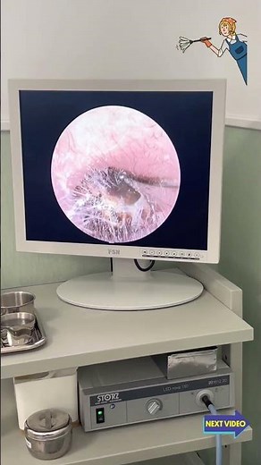 📸 Inside the Ear View — Wax Removed Perfectly! #shorts #endoscopy #healthcare