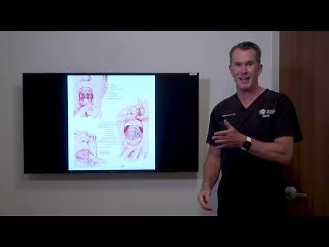 UPPP - Using thermal fusion & trimming the uvula / soft palate to treat Snoring/ Sleep Apnea