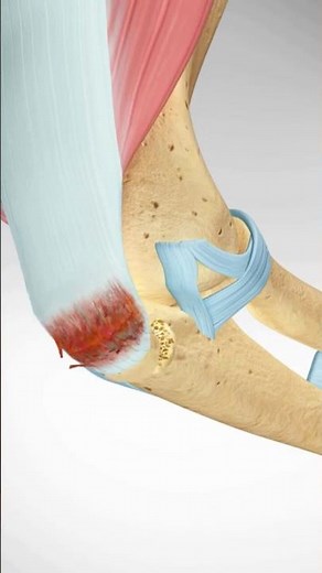 Triceps Tendon Avulsion and Surgical Repair #triceps #weightlifting