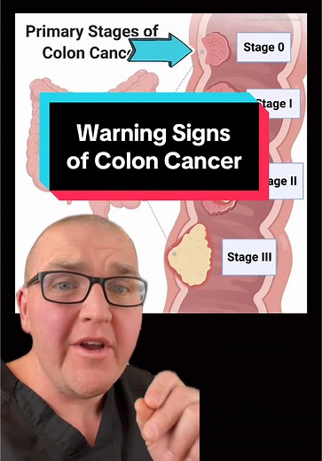 Recognizing the Warning Signs of Colon Cancer