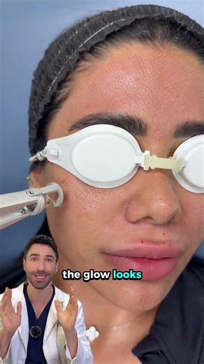 Would you trade one crusty week for smoother, brighter skin? #laser #antiaging #co2laser #exosomes