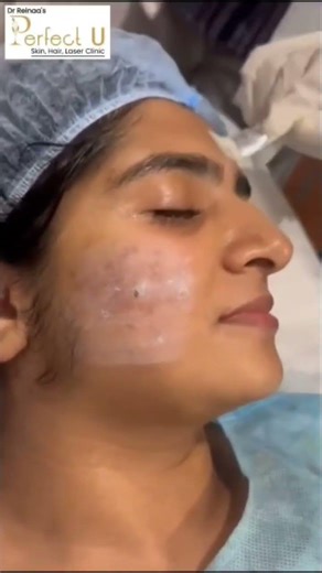 Say Goodbye to Acne & Scars ✨ Real Skin Treatment Result | Clinic Procedure #scarrevision #scarless