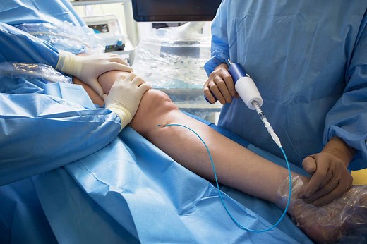 Glue Treatment For Varicose Veins | Vein Clinic Perth