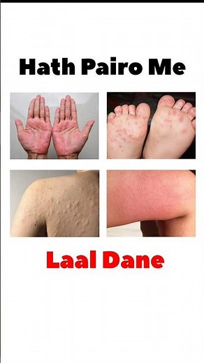 “Calamine Lotion: Itch, Rash aur Skin Irritation ka Instant Relief Solution 💊🔥”